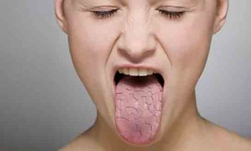 Boğaz Kuruması Belirtileri ve Tedavisi